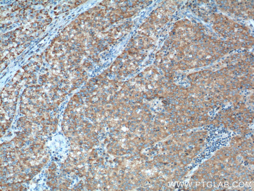IHC staining of human liver cancer using 13895-1-AP