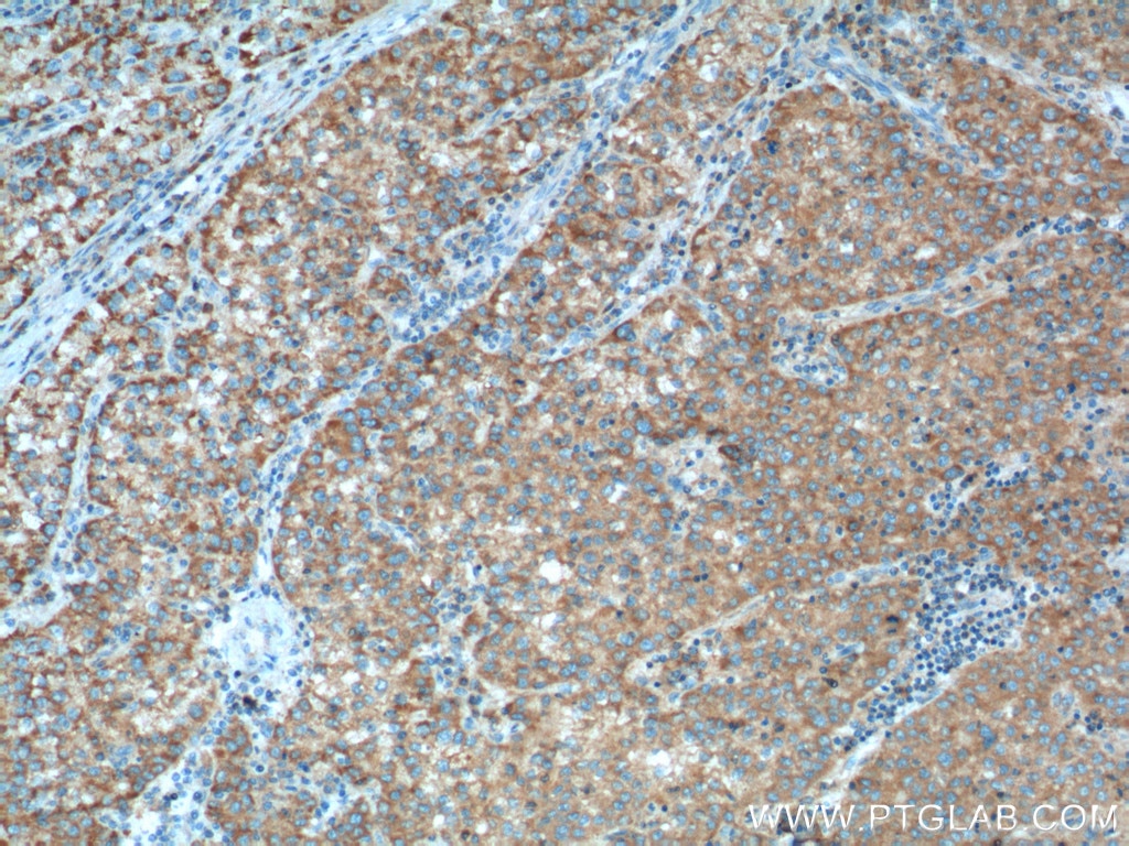 Immunohistochemistry (IHC) staining of human liver cancer tissue using D2HGDH Polyclonal antibody (13895-1-AP)