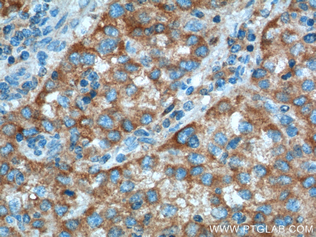 Immunohistochemistry (IHC) staining of human liver cancer tissue using D2HGDH Polyclonal antibody (13895-1-AP)