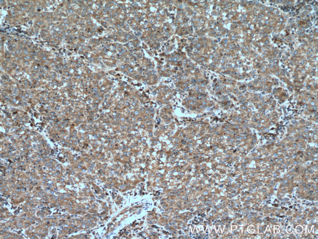 Immunohistochemistry (IHC) staining of human liver cancer tissue using D2HGDH Monoclonal antibody (66364-1-Ig)