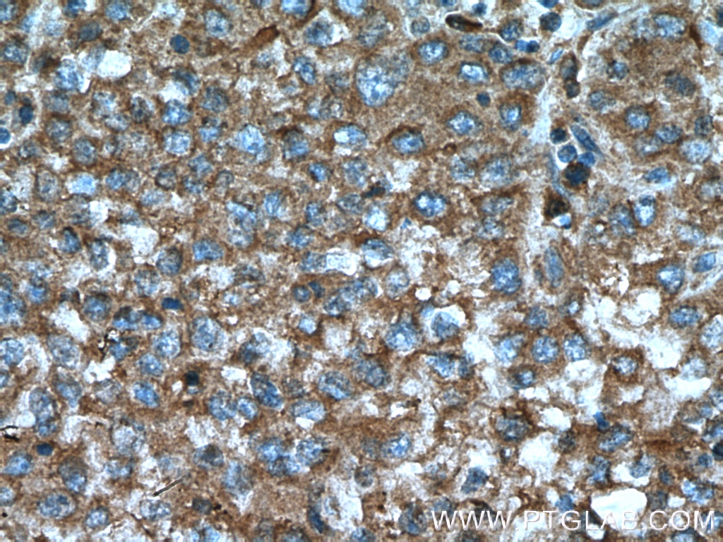 Immunohistochemistry (IHC) staining of human liver cancer tissue using D2HGDH Monoclonal antibody (66364-1-Ig)