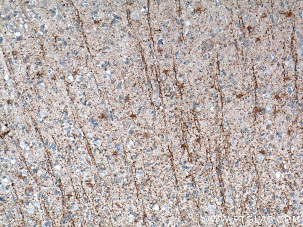 Immunohistochemistry (IHC) staining of human gliomas tissue using DAAM2 Polyclonal antibody (25206-1-AP)