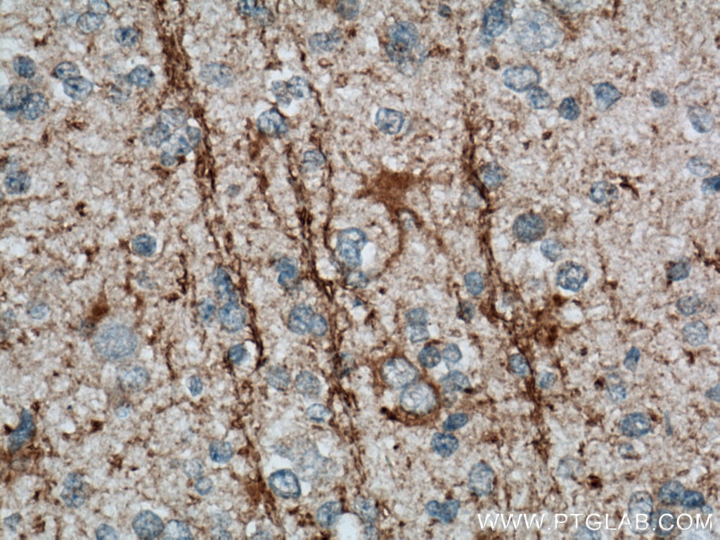 Immunohistochemistry (IHC) staining of human gliomas tissue using DAAM2 Polyclonal antibody (25206-1-AP)