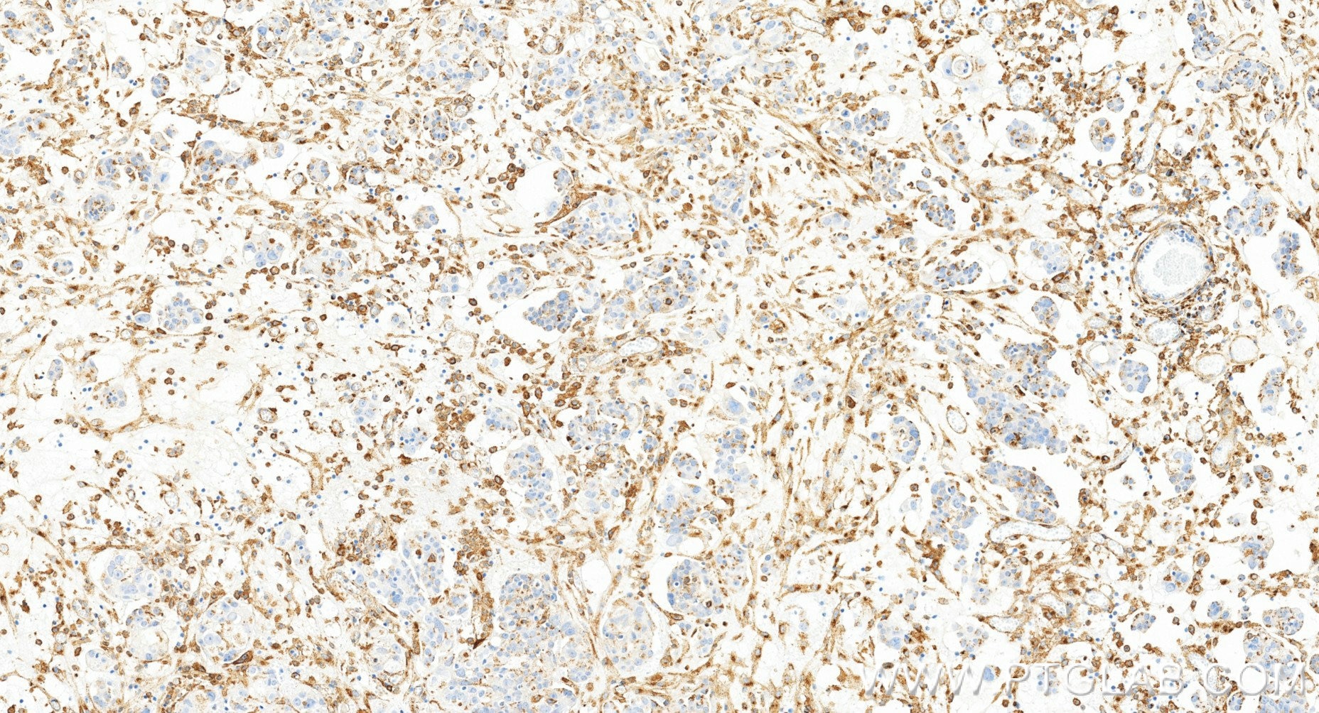 IHC staining of human ovary cancer using 86141-1-RR (same clone as 86141-1-PBS) Immunohistochemistry (IHC) staining of human ovary cancer tissue using DAB2 Recombinant monoclonal antibody (86141-1-RR)