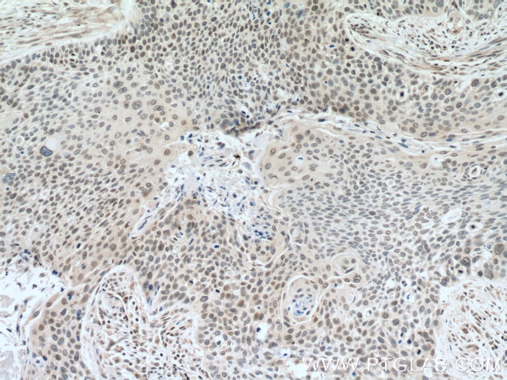 IHC staining of human oesophagus cancer using 10914-1-AP