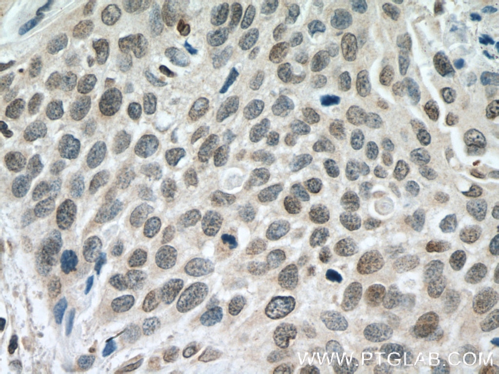 Immunohistochemistry (IHC) staining of human oesophagus cancer tissue using DACH1 Polyclonal antibody (10914-1-AP)