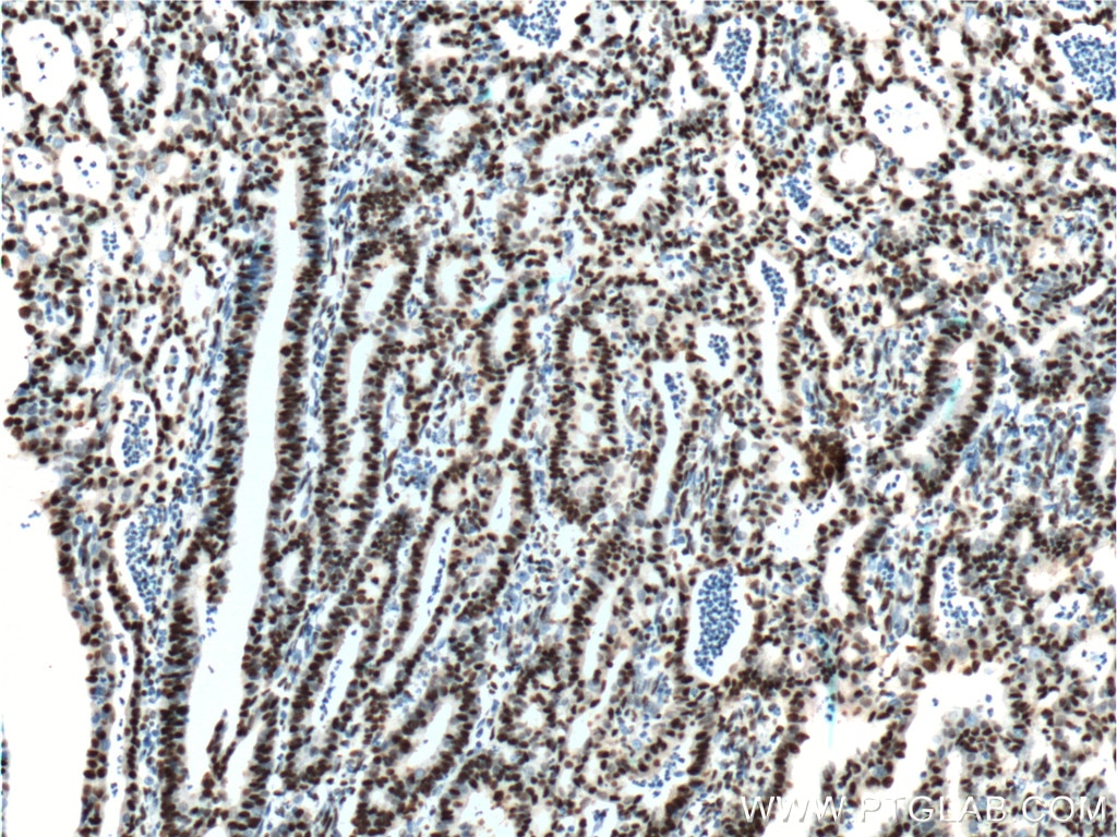 IHC staining of human endometrial cancer using 60082-1-Ig