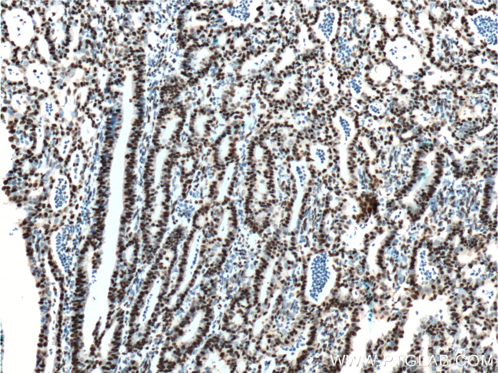 Immunohistochemistry (IHC) staining of human endometrial cancer tissue using DACH1 Monoclonal antibody (60082-1-Ig)