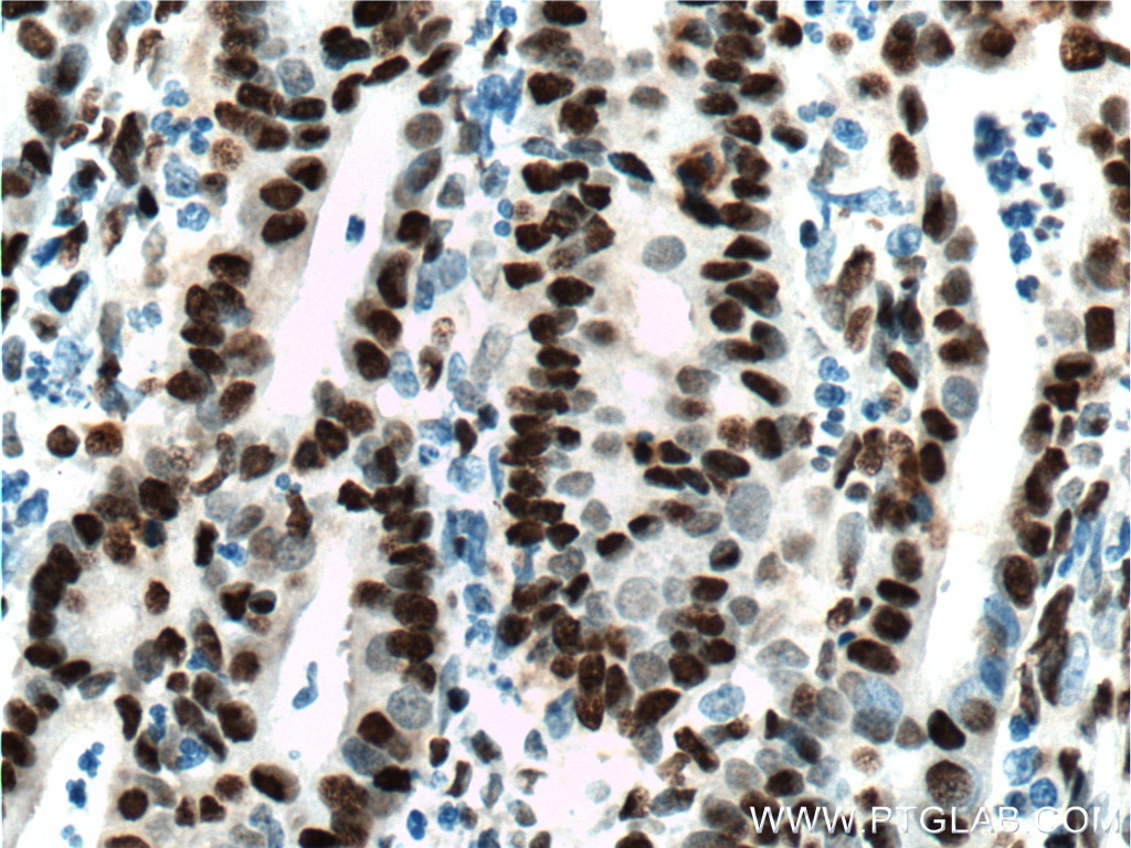 Immunohistochemistry (IHC) staining of human endometrial cancer tissue using DACH1 Monoclonal antibody (60082-1-Ig)