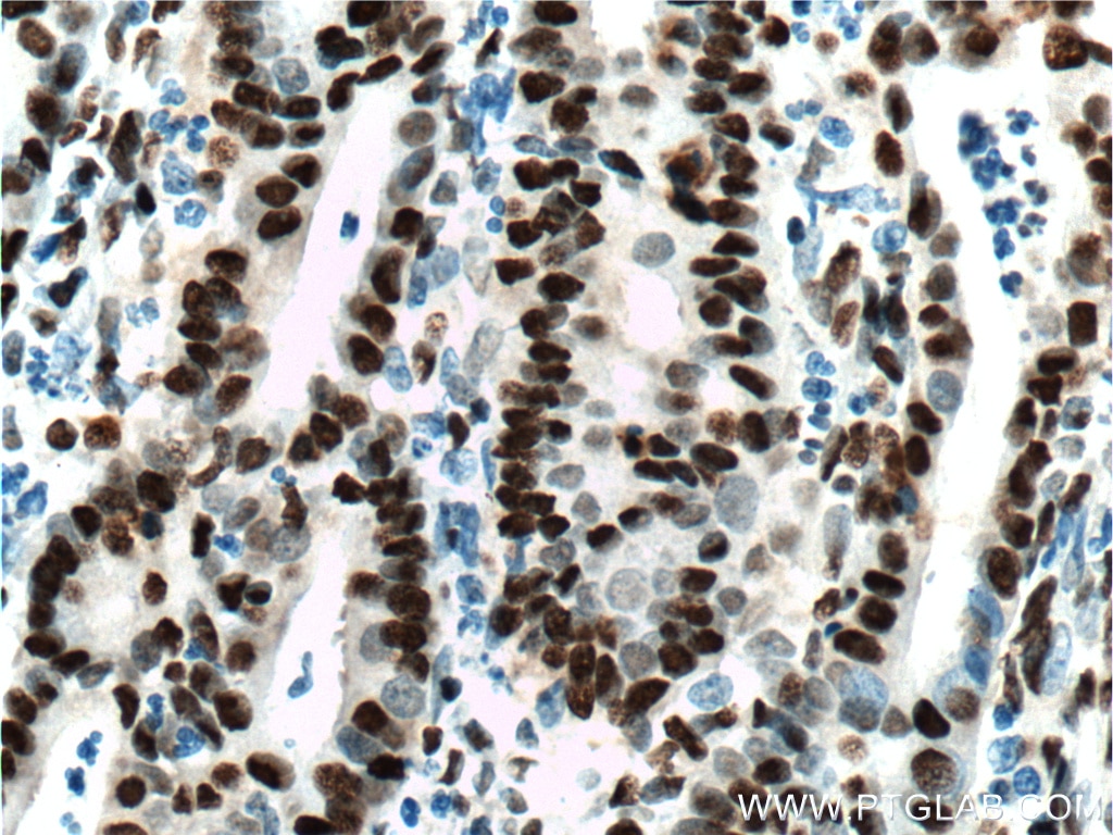 IHC staining of human endometrial cancer using 60082-1-Ig