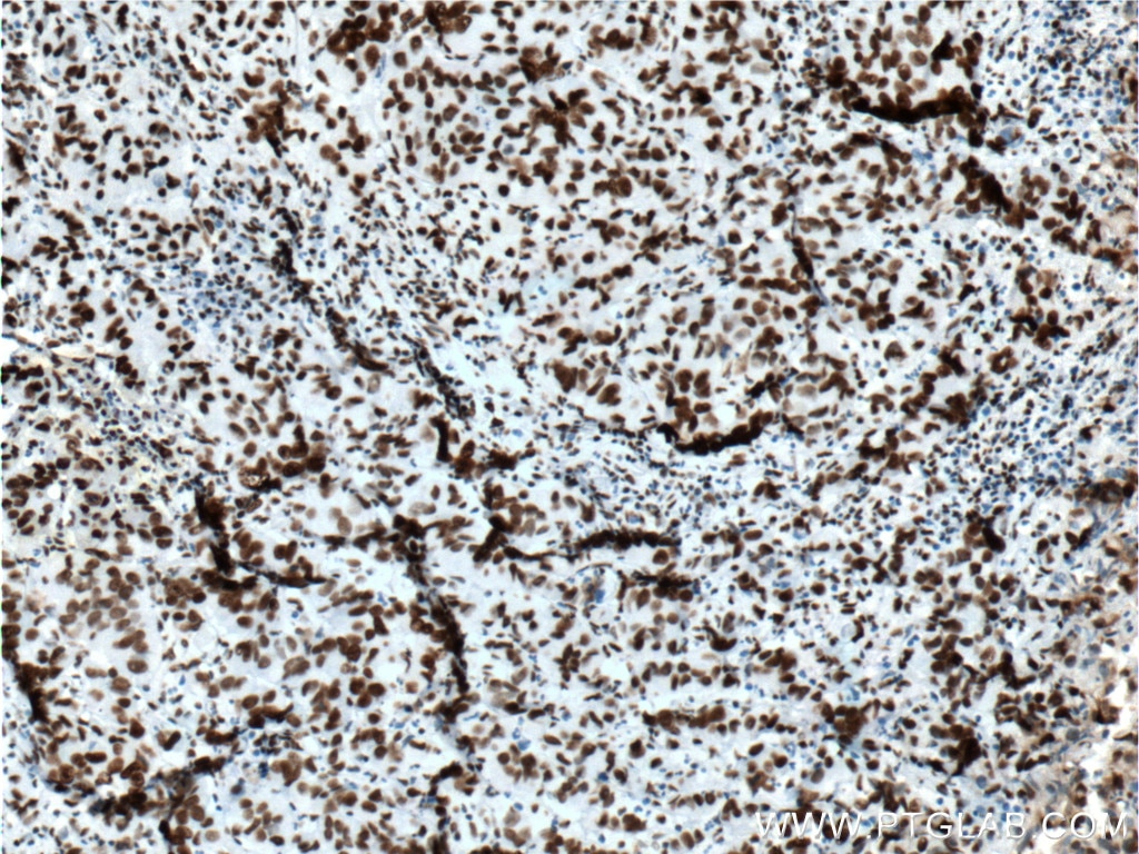 Immunohistochemistry (IHC) staining of human prostate cancer tissue using DACH1 Monoclonal antibody (60082-1-Ig)