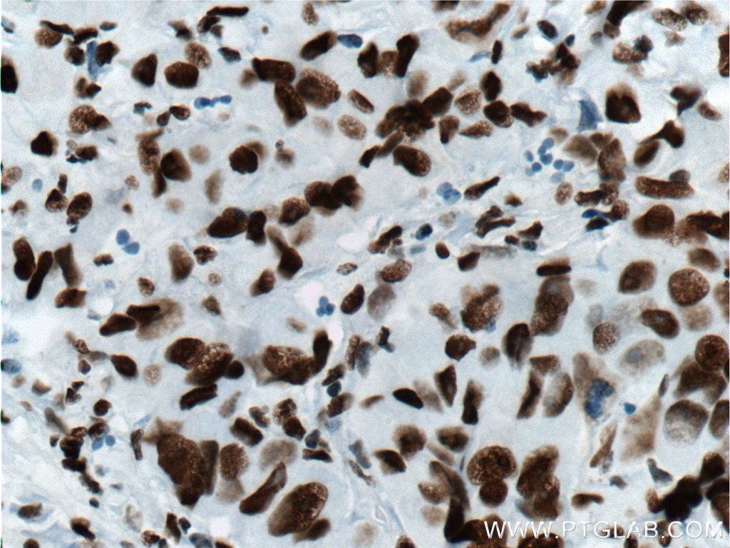 Immunohistochemistry (IHC) staining of human prostate cancer tissue using DACH1 Monoclonal antibody (60082-1-Ig)