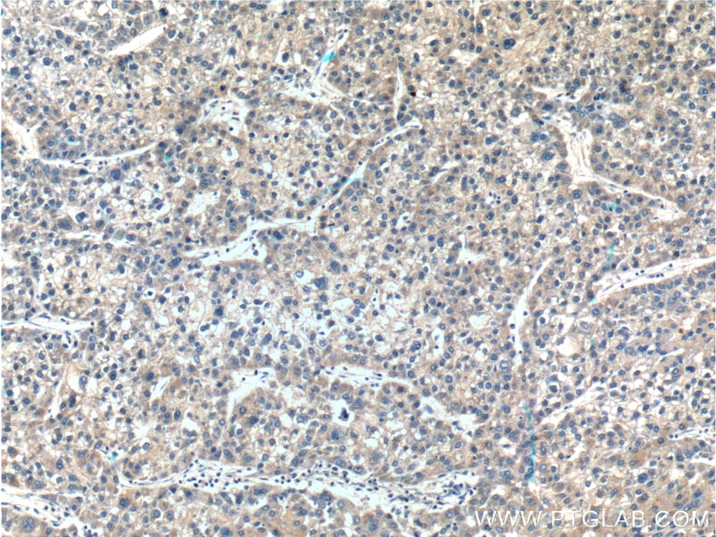 Immunohistochemistry (IHC) staining of human liver cancer tissue using DAD1 Polyclonal antibody (10531-1-AP)