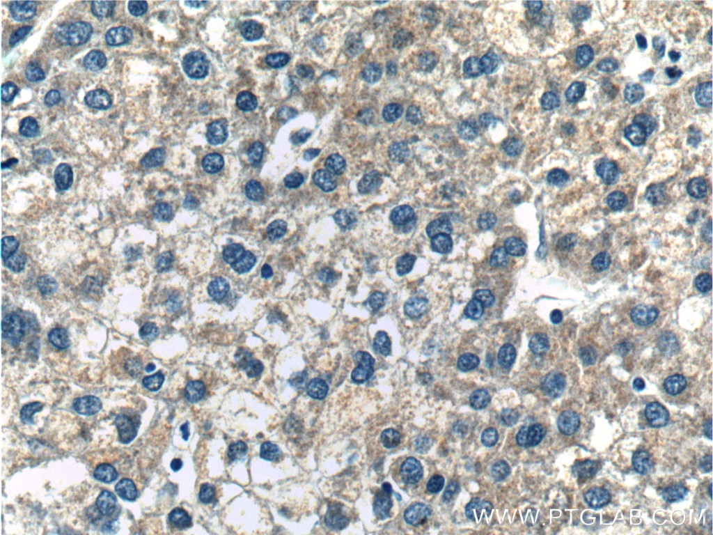 Immunohistochemistry (IHC) staining of human liver cancer tissue using DAD1 Polyclonal antibody (10531-1-AP)