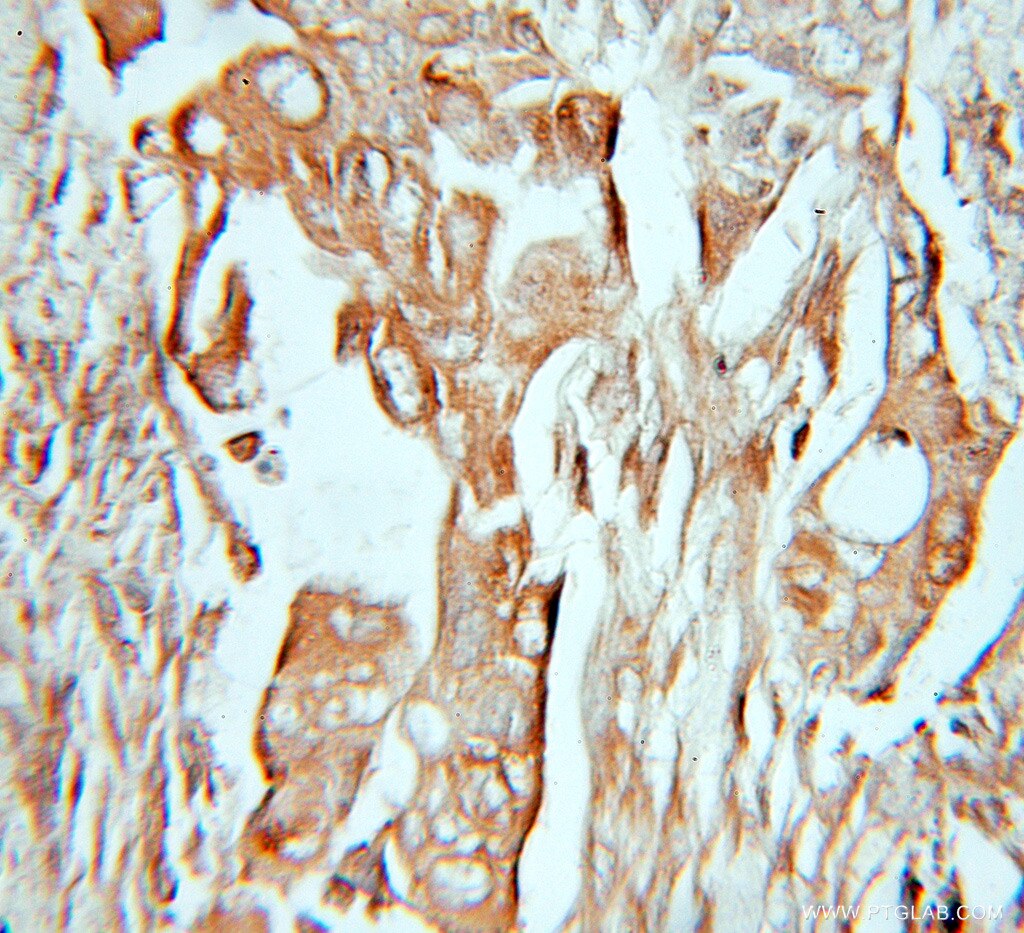 IHC staining of human lung cancer using 11017-1-AP