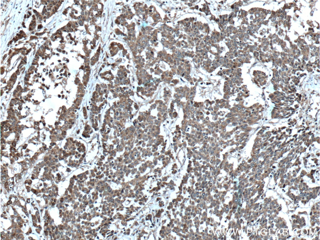 Immunohistochemistry (IHC) staining of human colon cancer tissue using DALRD3 Polyclonal antibody (26294-1-AP)