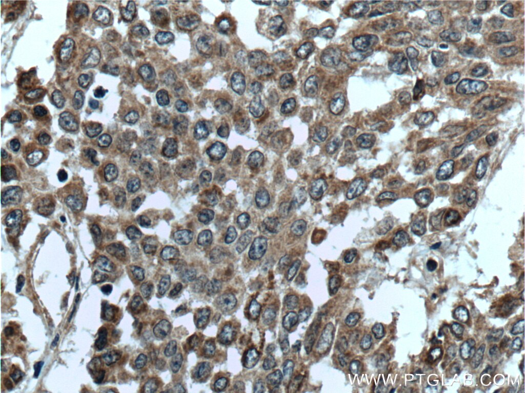 Immunohistochemistry (IHC) staining of human colon cancer tissue using DALRD3 Polyclonal antibody (26294-1-AP)