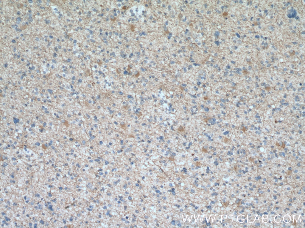 IHC staining of human gliomas using 66296-1-Ig