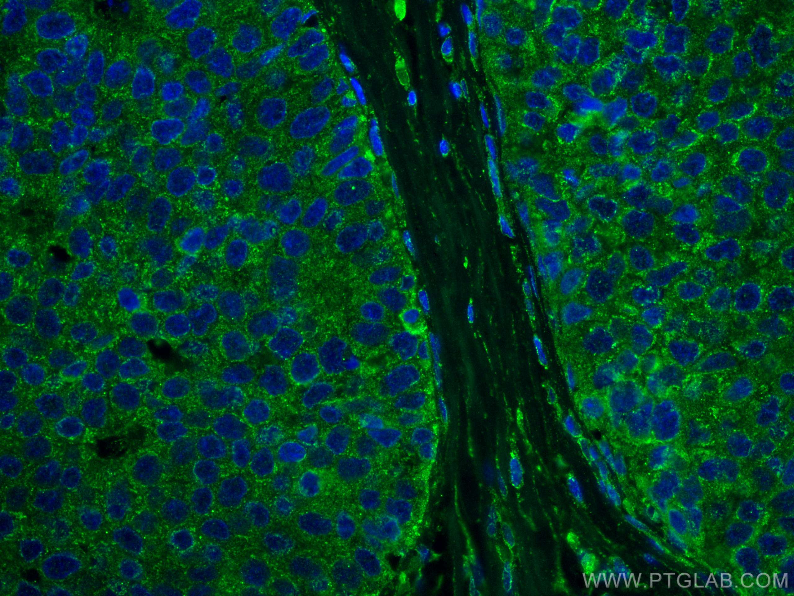 Immunofluorescence (IF) / fluorescent staining of human breast cancer tissue using DAPK1 Monoclonal antibody (67815-1-Ig)