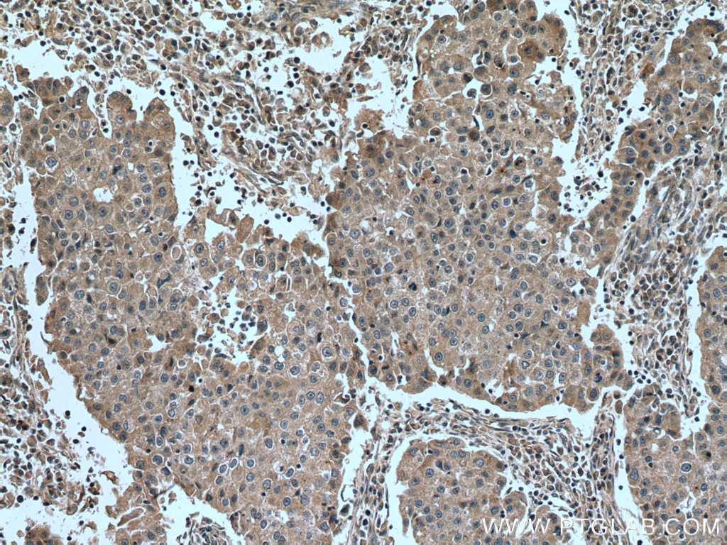 Immunohistochemistry (IHC) staining of human breast cancer tissue using DAPK1 Monoclonal antibody (67815-1-Ig)