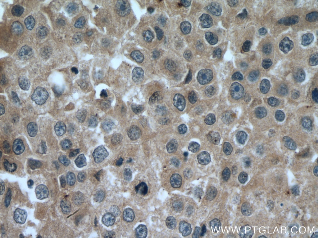 Immunohistochemistry (IHC) staining of human breast cancer tissue using DAPK1 Monoclonal antibody (67815-1-Ig)