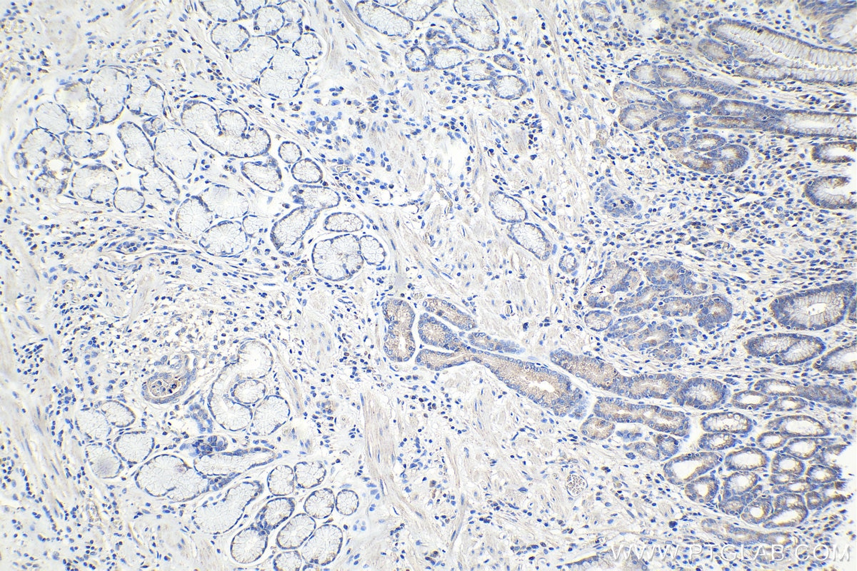 Immunohistochemistry (IHC) staining of human stomach cancer tissue using DAPK1 Monoclonal antibody (67815-1-Ig)