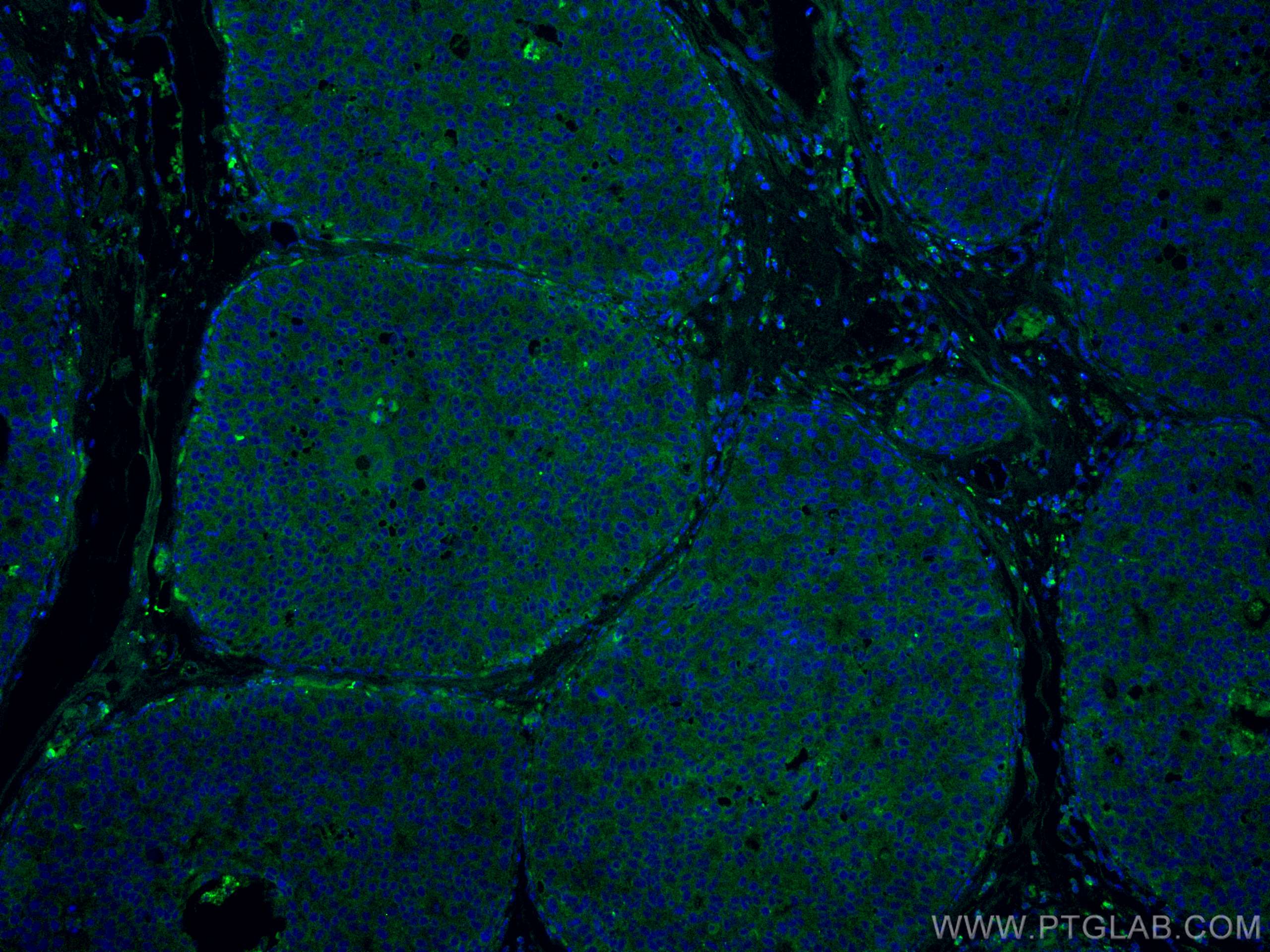 Immunofluorescence (IF) / fluorescent staining of human breast cancer tissue using CoraLite® Plus 488-conjugated DAPK1 Monoclonal ant (CL488-67815)