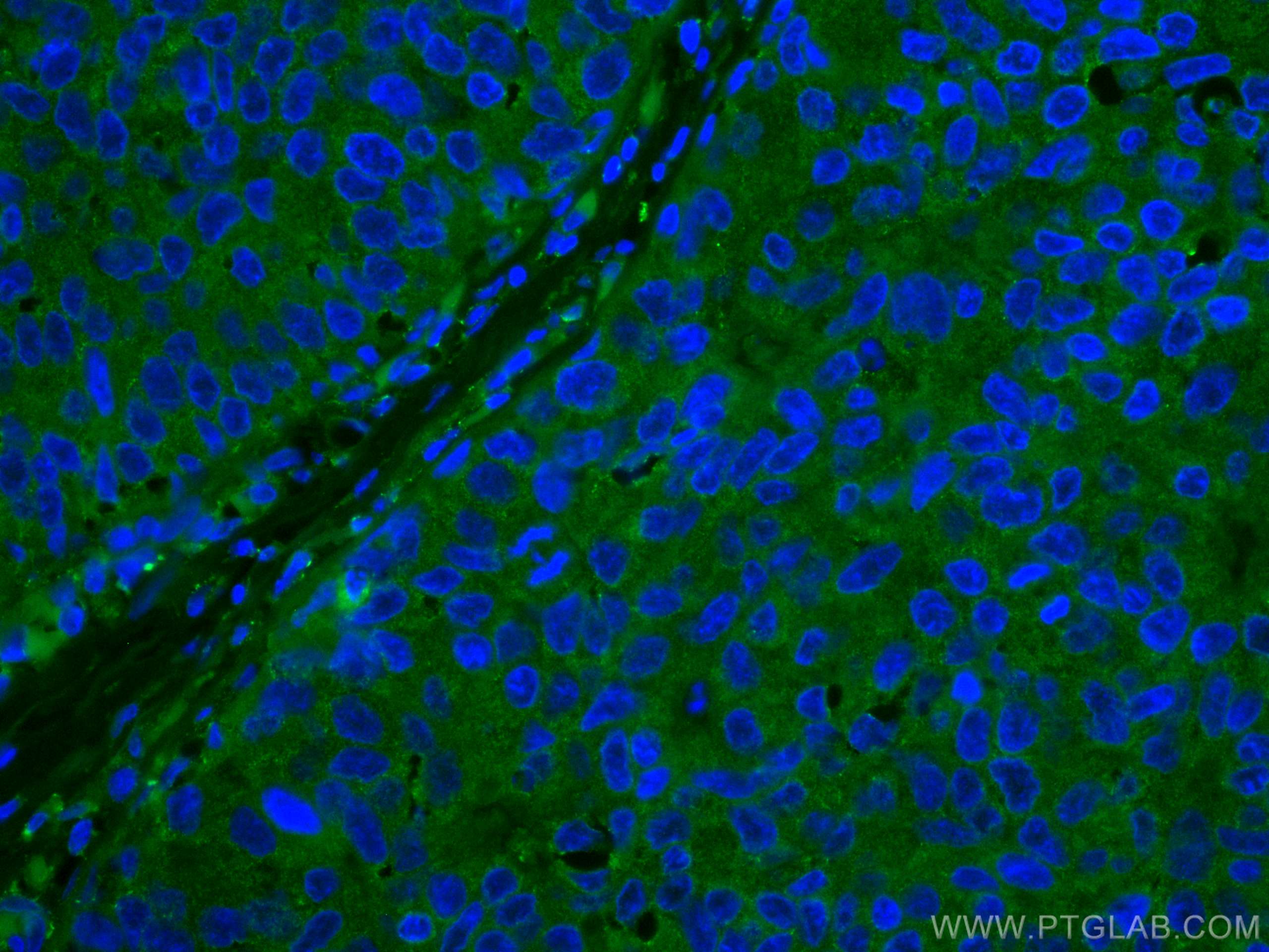 Immunofluorescence (IF) / fluorescent staining of human breast cancer tissue using CoraLite® Plus 488-conjugated DAPK1 Monoclonal ant (CL488-67815)