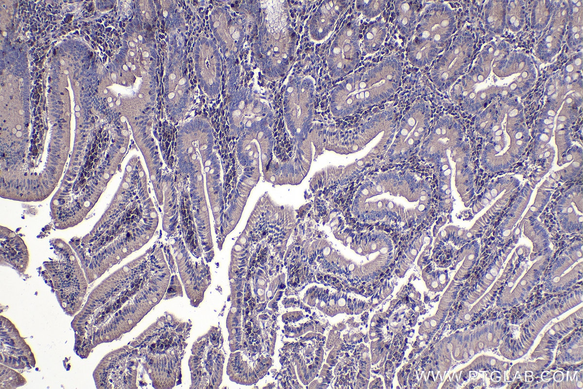 Immunohistochemistry (IHC) staining of human stomach cancer tissue using ZIP kinase Polyclonal antibody (19540-1-AP)