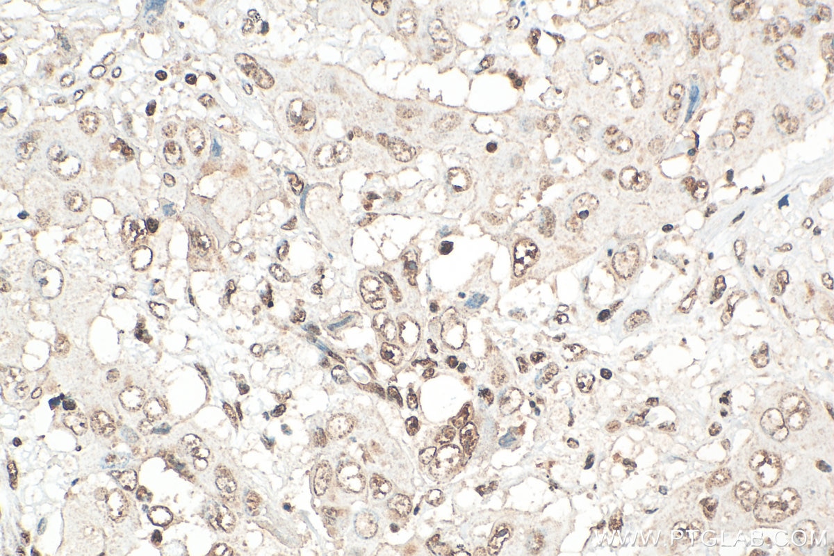 Immunohistochemistry (IHC) staining of human lung cancer tissue using DAPK3 Polyclonal antibody (30656-1-AP)