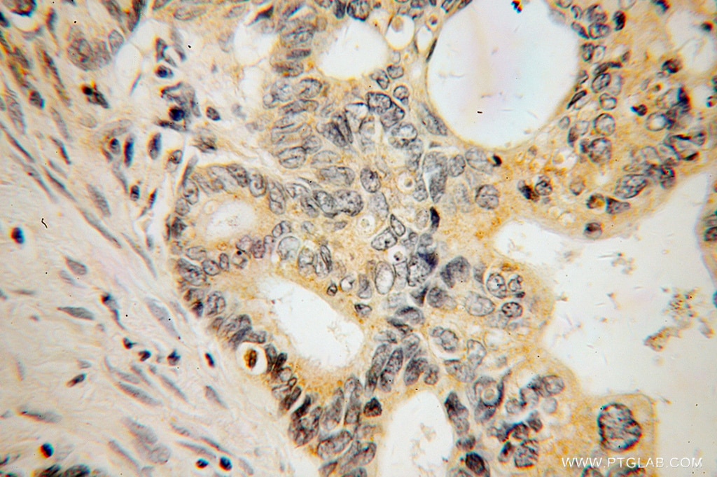 Immunohistochemistry (IHC) staining of human liver cancer tissue using DAPP1 Polyclonal antibody (14722-1-AP)