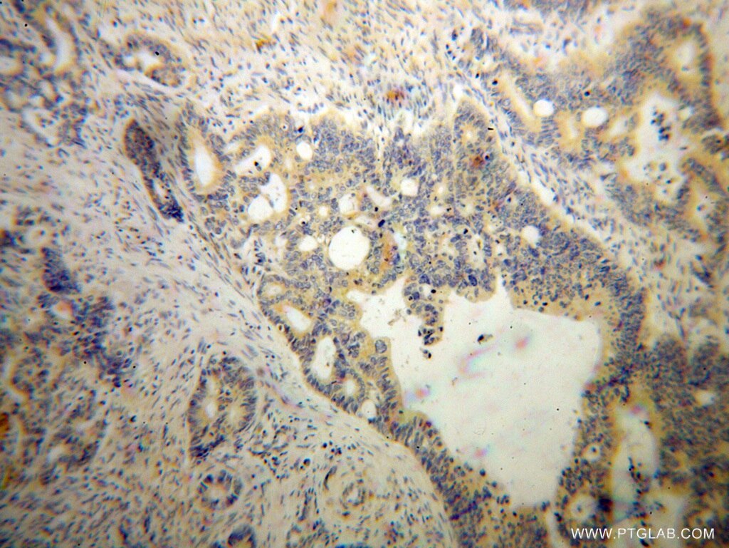 Immunohistochemistry (IHC) staining of human liver cancer tissue using DAPP1 Polyclonal antibody (14722-1-AP)