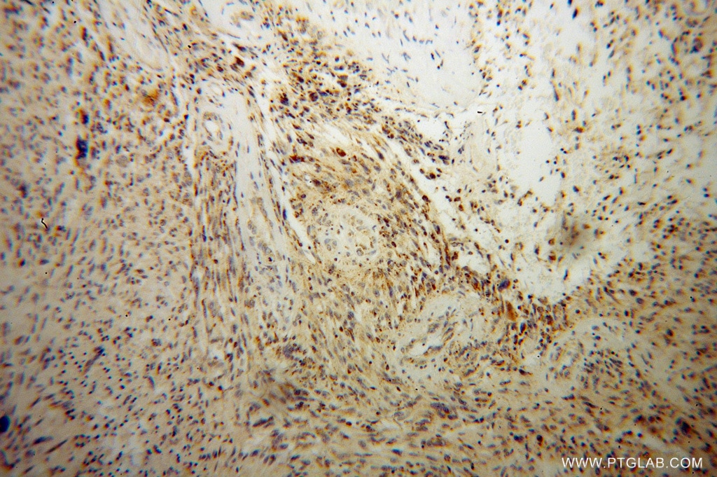 Immunohistochemistry (IHC) staining of human gliomas tissue using DARS2 Polyclonal antibody (13807-1-AP)