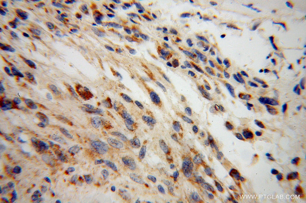 IHC staining of human gliomas using 13807-1-AP
