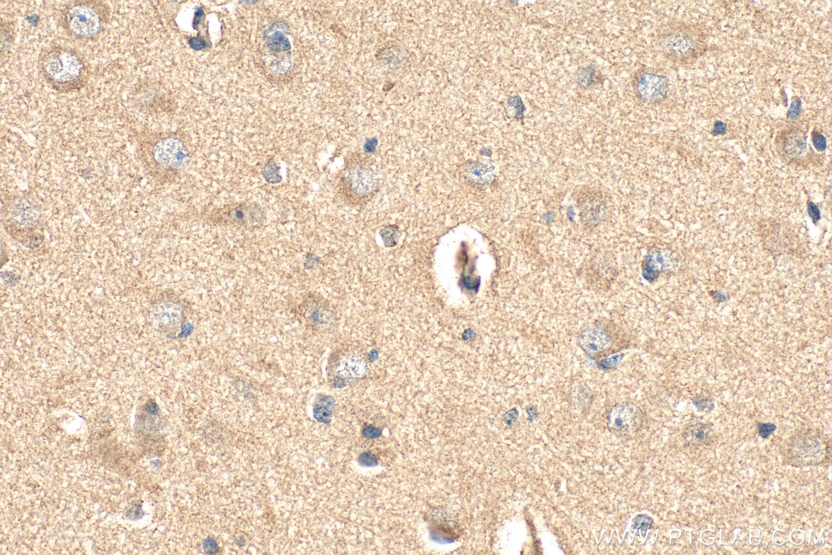 Immunohistochemical analysis of paraffin-embedded human gliomas tissue slide using RMX00040 (DARS2 antibody) at dilution of 1:200 (under 40x lens). Heat mediated antigen retrieval with Tris-EDTA buffer (pH 9.0). Immunohistochemistry (IHC) staining of human gliomas tissue using Multi-rAb® DARS2 Multi-Recombinant antibody (RMX00040)