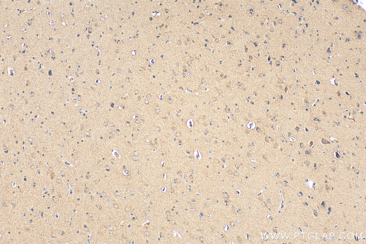 Immunohistochemical analysis of paraffin-embedded human gliomas tissue slide using RMX00040 (DARS2 antibody) at dilution of 1:200 (under 10x lens). Heat mediated antigen retrieval with Tris-EDTA buffer (pH 9.0). Immunohistochemistry (IHC) staining of human gliomas tissue using Multi-rAb® DARS2 Multi-Recombinant antibody (RMX00040)