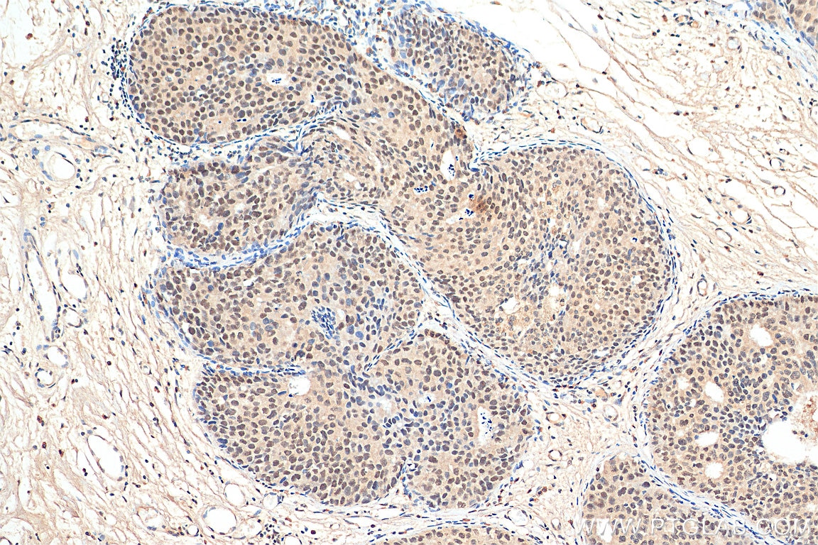 Immunohistochemistry (IHC) staining of human breast cancer tissue using DAXX Monoclonal antibody (67879-1-Ig)