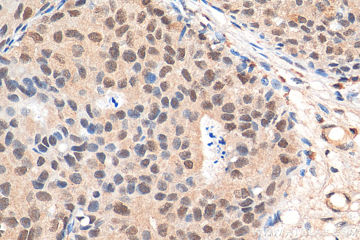 Immunohistochemistry (IHC) staining of human breast cancer tissue using DAXX Monoclonal antibody (67879-1-Ig)