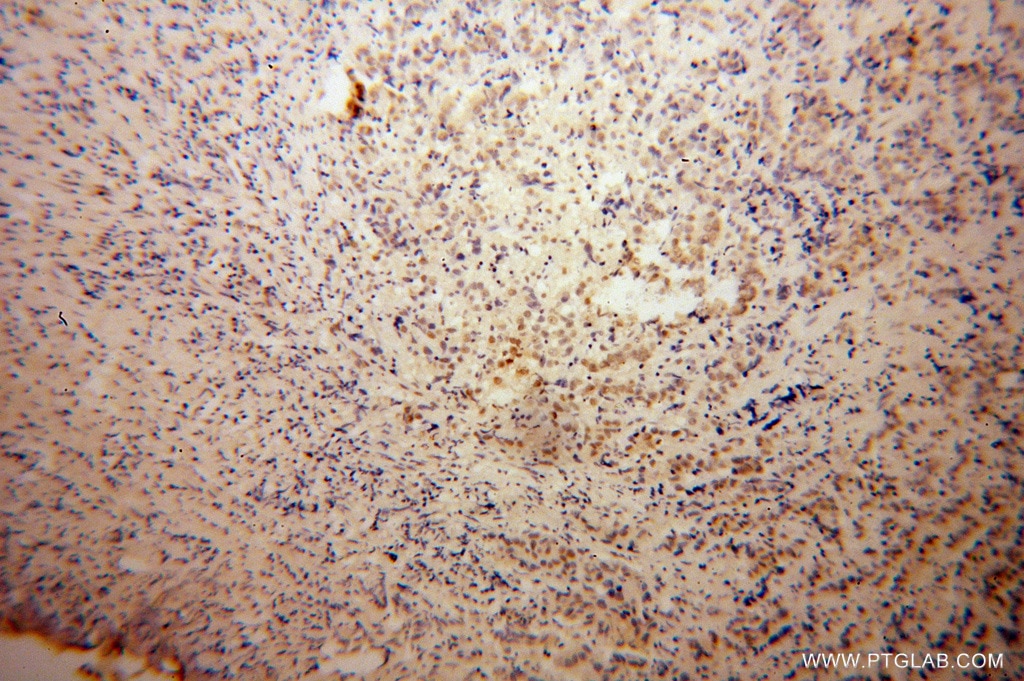 Immunohistochemistry (IHC) staining of human prostate cancer tissue using DAZAP1 Polyclonal antibody (11120-1-AP)