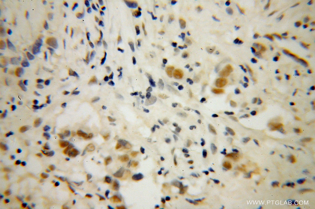 Immunohistochemistry (IHC) staining of human prostate cancer tissue using DAZAP1 Polyclonal antibody (11120-1-AP)