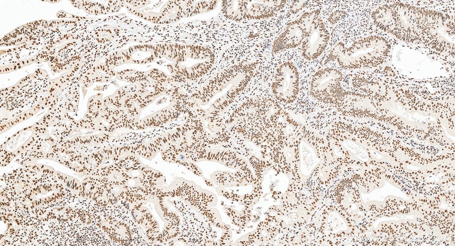 IHC staining of human colon cancer using 22638-1-AP Immunohistochemistry (IHC) staining of human colon cancer tissue using CCAR2 Polyclonal antibody (22638-1-AP)