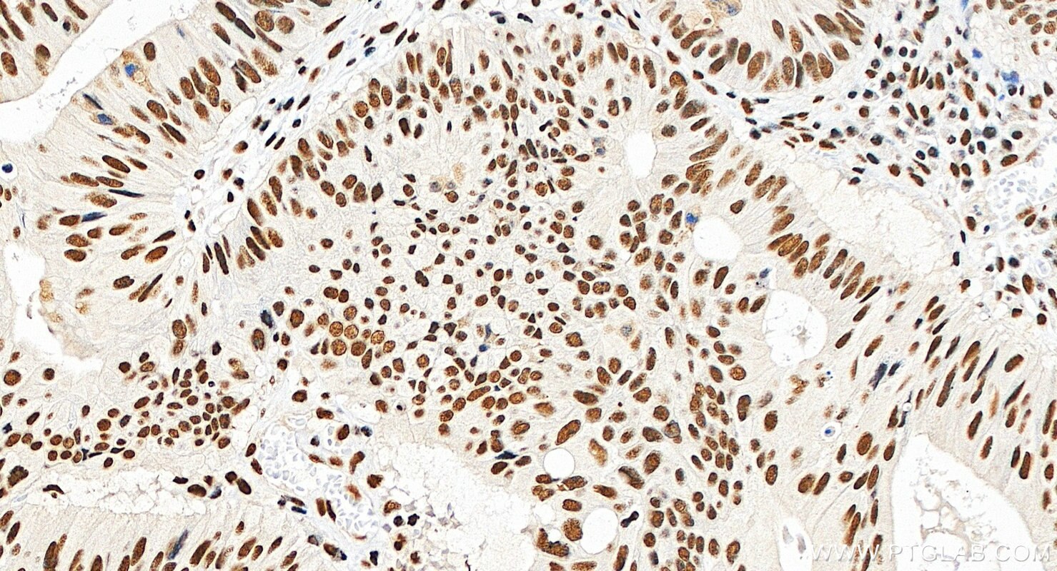 IHC staining of human colon cancer using 22638-1-AP Immunohistochemistry (IHC) staining of human colon cancer tissue using CCAR2 Polyclonal antibody (22638-1-AP)