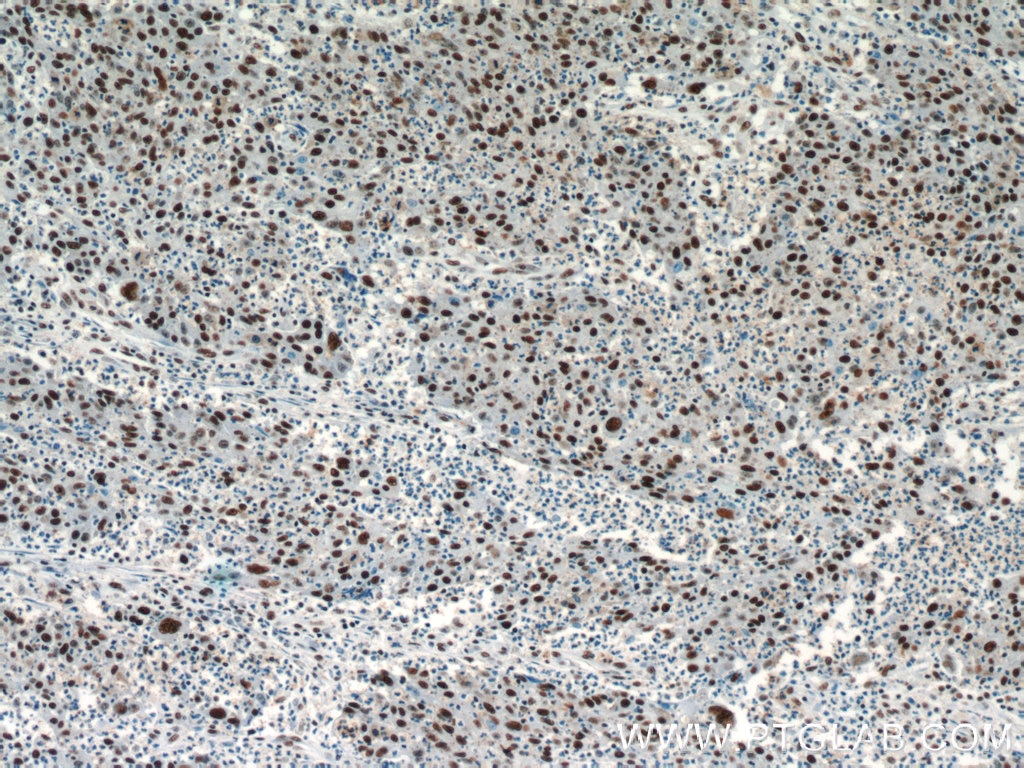 Immunohistochemistry (IHC) staining of human colon cancer tissue using CCAR2 Polyclonal antibody (22638-1-AP)