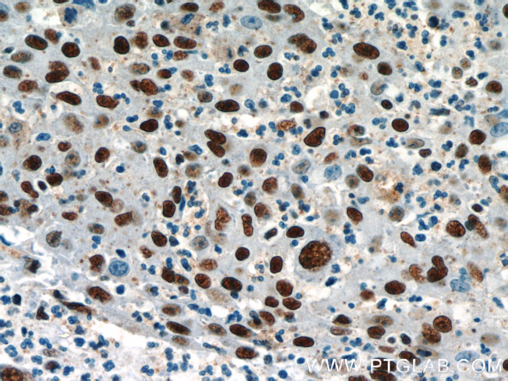 Immunohistochemistry (IHC) staining of human colon cancer tissue using CCAR2 Polyclonal antibody (22638-1-AP)