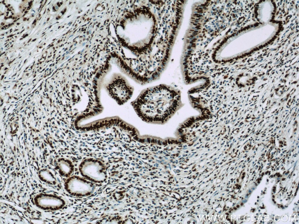 IHC staining of human pancreas cancer using 22638-1-AP