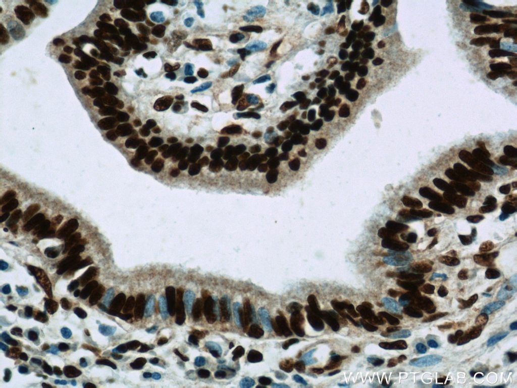 Immunohistochemistry (IHC) staining of human pancreas cancer tissue using CCAR2 Polyclonal antibody (22638-1-AP)