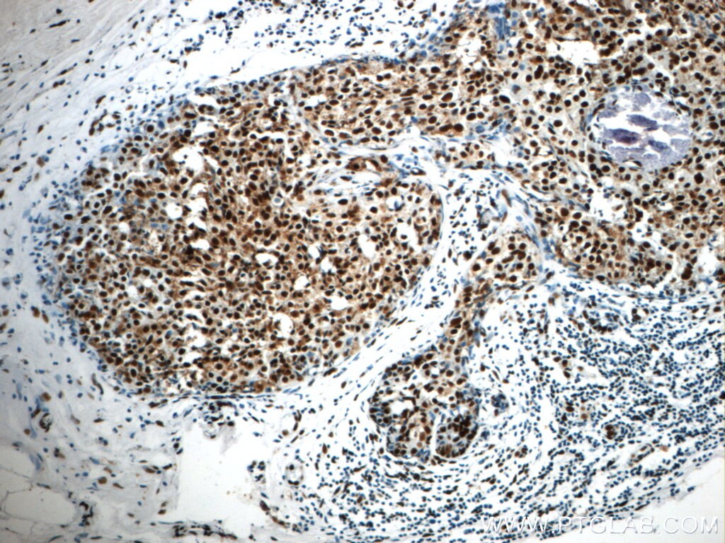 Immunohistochemistry (IHC) staining of human breast cancer tissue using CCAR2 Polyclonal antibody (22638-1-AP)
