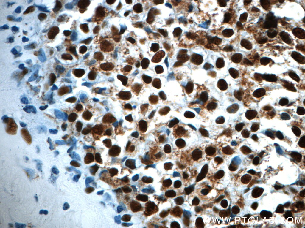 Immunohistochemistry (IHC) staining of human breast cancer tissue using CCAR2 Polyclonal antibody (22638-1-AP)