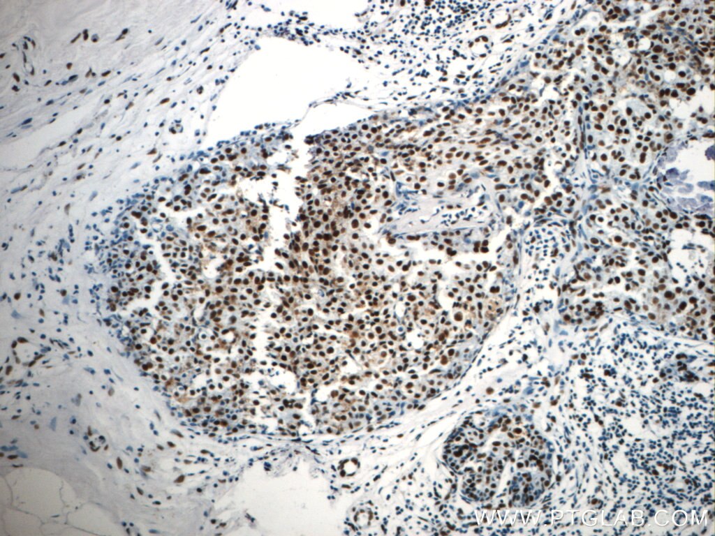 IHC staining of human breast cancer using 22638-1-AP