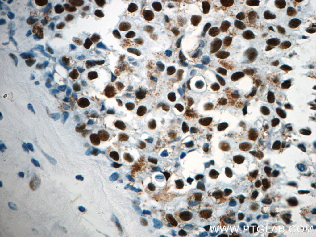 Immunohistochemistry (IHC) staining of human breast cancer tissue using CCAR2 Polyclonal antibody (22638-1-AP)
